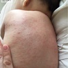 乳児湿疹⑧ー経過ー