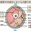 筋膜リリースで、腰痛は改善するの？それには骨盤をゆがめる大腿四頭筋を解くことが大事です！