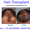 Hair Transplant to Overcome Baldness and Have Younger Looks