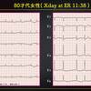 ECG-310：80才代女性。心不全発作での搬入です。