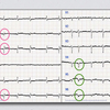 ECG-119：answer