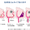 アテローム性、心原性、ラクナ脳梗塞の鑑別