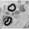 CIDPの病理所見に関する包括的調査（Gesnparkバージョン）