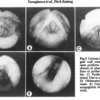 ピッチを上げるための声門上の寄与．スペクトル解析による内視鏡研究