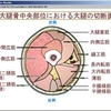 人体断面図でしこりやすい場所の予測