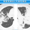 大葉性肺炎と気管支肺炎の違い