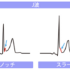 早期再分極心電図の特徴と意義