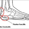 The Diagnosis Of Calcaneal Spur