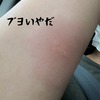 噛まれる？刺される？キャンプでのブヨ（ブユ）被害の体験談。噛まれる人・噛まれない人の違いは？