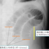 小腸閉塞のレントゲン所見（３✕３ルール）