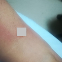 微グロ画像注意 虫に刺されて 水ぶくれ ができたので皮膚科に行ってきました もえろぐ