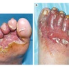 Toe web infection