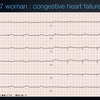 ECG-150：97歳女性。心不全の終末期です。