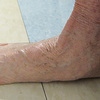 Flat Foot Problems In Adults