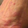 What Is Lichen Planus Causes, Symptoms And Treatment