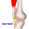 膝の痛みと膝蓋下脂肪体