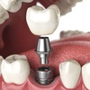 Vì sao nói trồng răng implant là giải pháp răng giả tốt nhất?