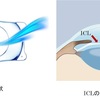 ICL(眼内コンタクトレンズ)考察　人生のQOL向上委員会