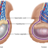 精巣捻転　精索捻転　睾丸痛