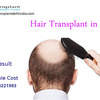 Hair Loss Treatments for Retaining Hairs and Transplant to Regain Them Artificially