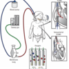 新生児～小児期のECMO後フォローアップが必要である。という論文
