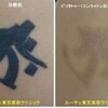 腕の濃いべったりとしたタトゥーを薄くしました