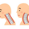 ストレートネック　慢性的な姿勢の悪さにより作られる首の歪みと症状について
