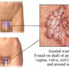 Alasan Mengapa Muncul Kutil Di Area Kelamin 