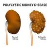 What Are the Options For Polycystic Kidney Disease Treatment?