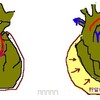 心タンポナーデの病態生理
