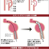 大動脈瘤、潜むリスク