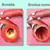 Bagaimana Menyembuhkan Penyakit Bronkitis Yang Alami