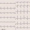 ECG-169：40才代女性。発熱精査でERで記録した心電図です。