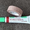 ルビーレーザーでADM（あざ）を消す！治療経過①（当日）