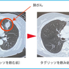 皮膚は悲惨な状態だけど、がんは小さくなってるようです。