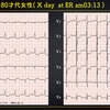 ECG-304：80才代女性。三日前からの胸痛発作と倦怠感です。