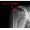 カルシウム飲んでたら石灰化した。
