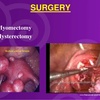 FIBROIDS SURGERY