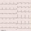 ECG-234：60才代女性。胸が切なくなって救急搬入です。