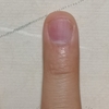 男だけど爪甲剥離症 爪が剥がれてるみたいな感じで治らないので皮膚科で見てもらった 1日目 Tm旅道楽 男だけど爪甲剥離症 爪が剥がれてるみたいな感じで治らないので皮膚科で見てもらった 1日目 Tm旅道楽