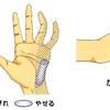 手のしびれの原因となる「肘部管症候群」について整形外科医が解説してみました 