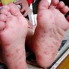 Do You Have Hard Skin On The Bottom Of Your Foot?
