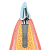 インプラントって何？