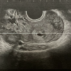 YUCHIの体外受精ブログVol.25 SAC　第３回目チャレンジ：⑦【BT18】妊娠継続検査１回目（胎嚢確認）