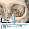 山口蛍が鼻骨骨折&左眼窩底骨折の重症！全治は？