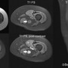 What Is Mortons Neuroma