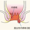 手術内容 〜結紮切除術+ジオン注射+肛門括約筋を切開〜