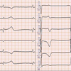 ECG-204：90才代女性。徐脈と心原性ショックでERヘ。