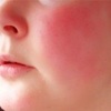 【赤ら顔治療39】赤ら顔にビタミンKが効く？は本当か