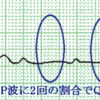 高度房室ブロックと２：１房室ブロックの違い